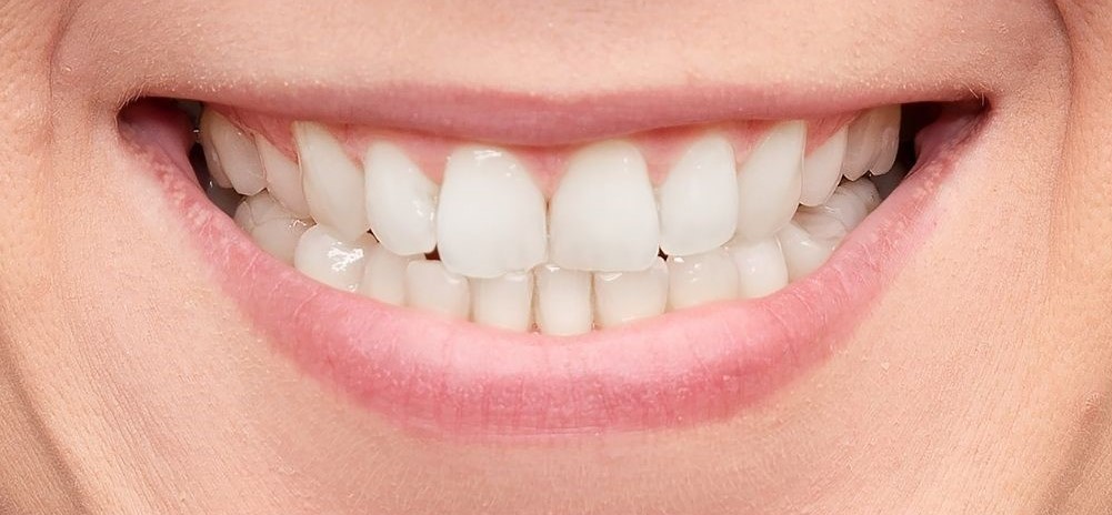 Clean stained teeth