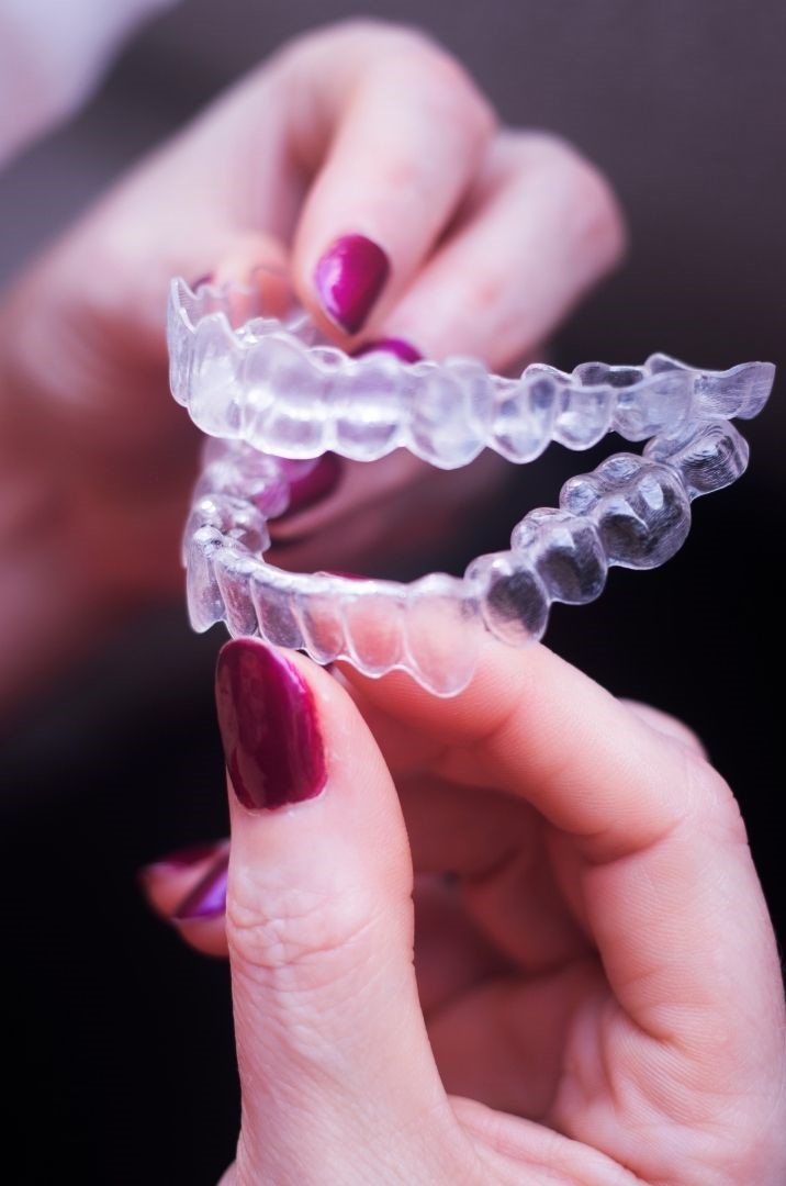 Clear aligner example