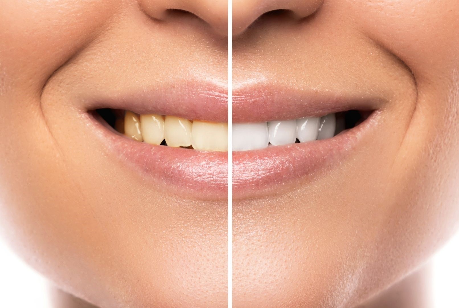 Teeth Whitening Difference