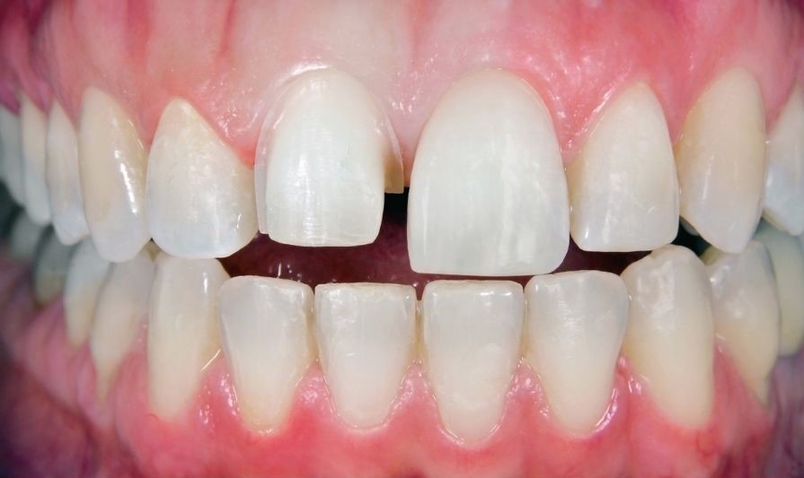 Dental Crown (2) - Copy