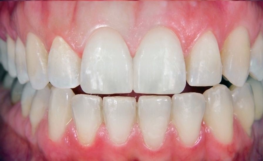Dental Crown (2)