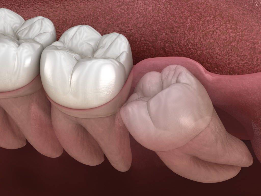 Healthy,Teeth,And,Wisdom,Tooth,With,Mesial,Impaction,.,Medically